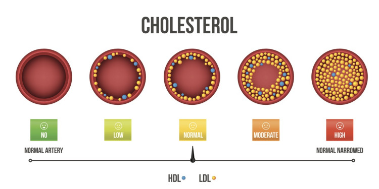 Abbildung 2: Rolle von HDL- und LDL-Cholesterin bei der Verdickung der Blutgefäße